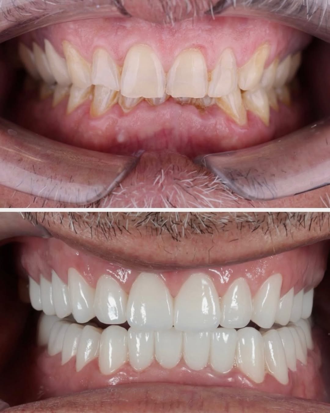 smile before after