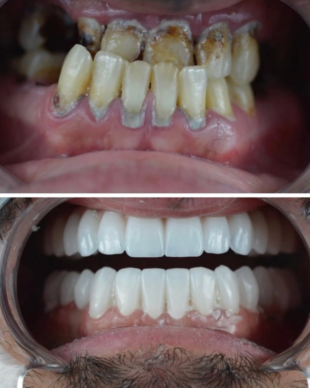 smile before after